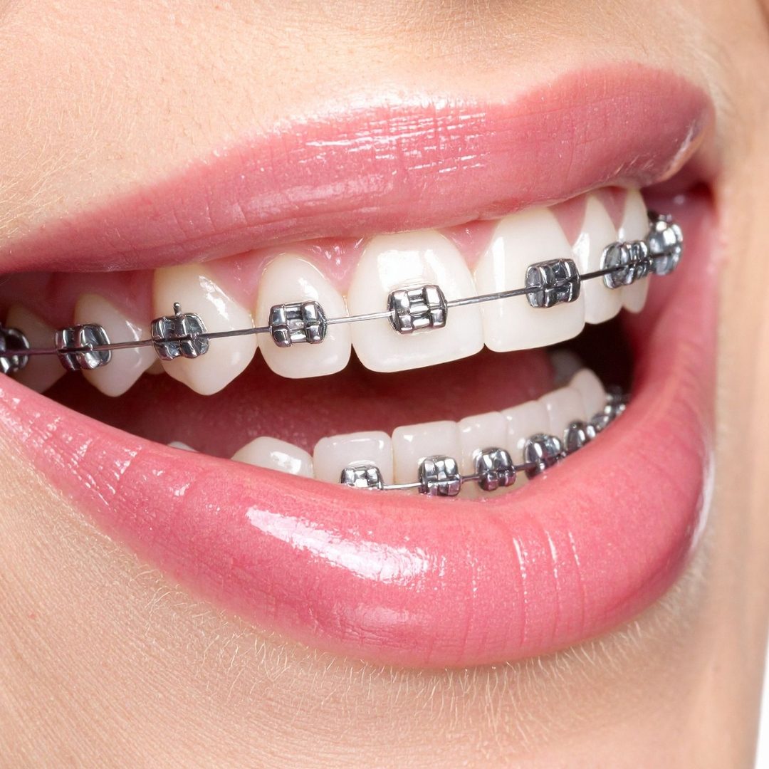 Braces at Ogilvie Dental in Gloucester