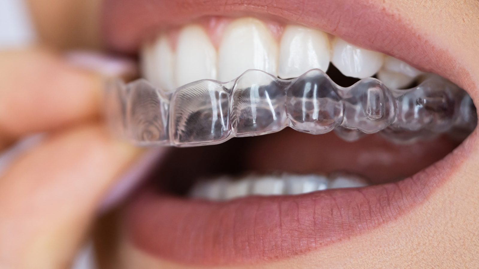 Clear Aligners at Ogilvie Dental in Gloucester