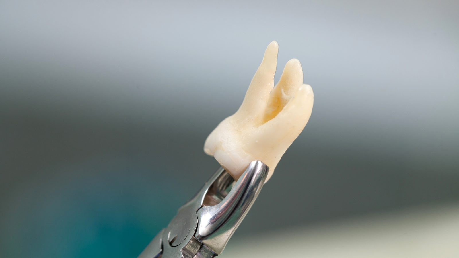 Wisdom Teeth Removal at Ogilvie Dental in Gloucester