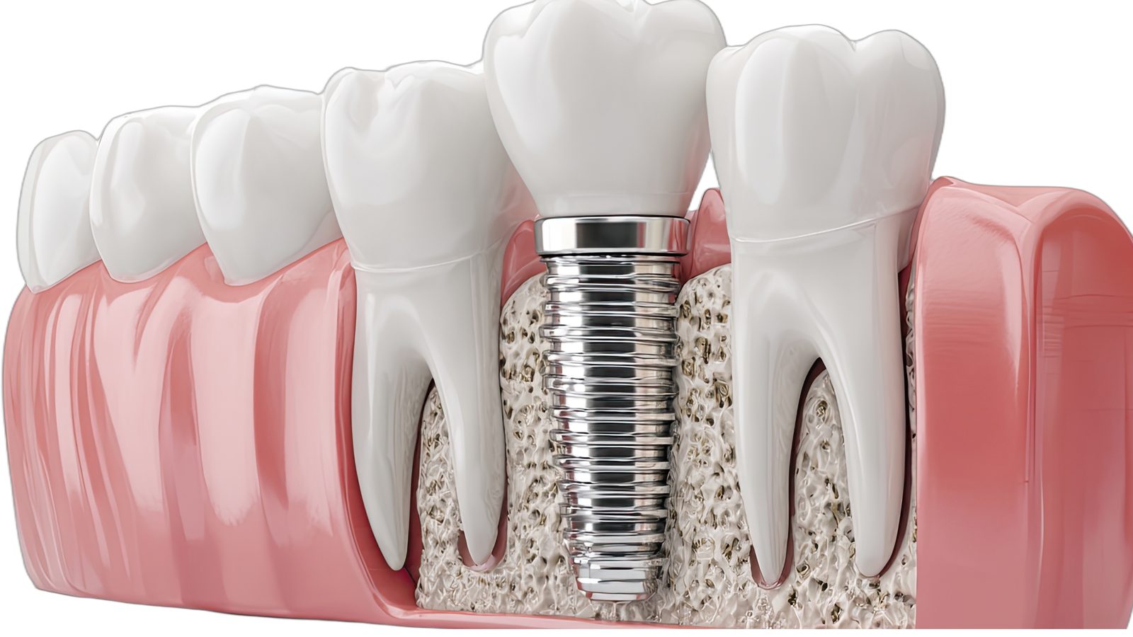 Dental Implants at Ogilvie Dental in Gloucester