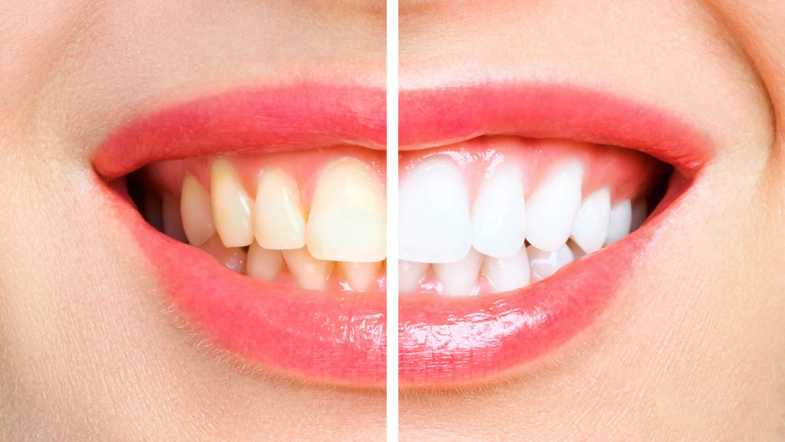 Teeth Whitening at Ogilvie Dental in Gloucester